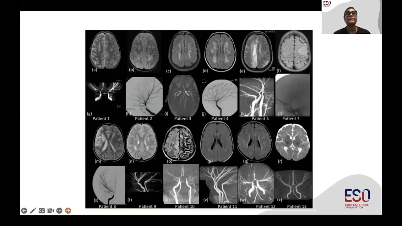 Moyamoya vasculopathy: epidemiology, clinical presentation, and natural course