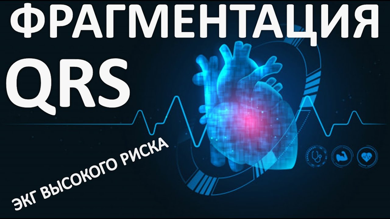 Фрагментация QRS &ndash; ЭКГ высокого риска. Определение, механизмы возникновения, клиническое значение.