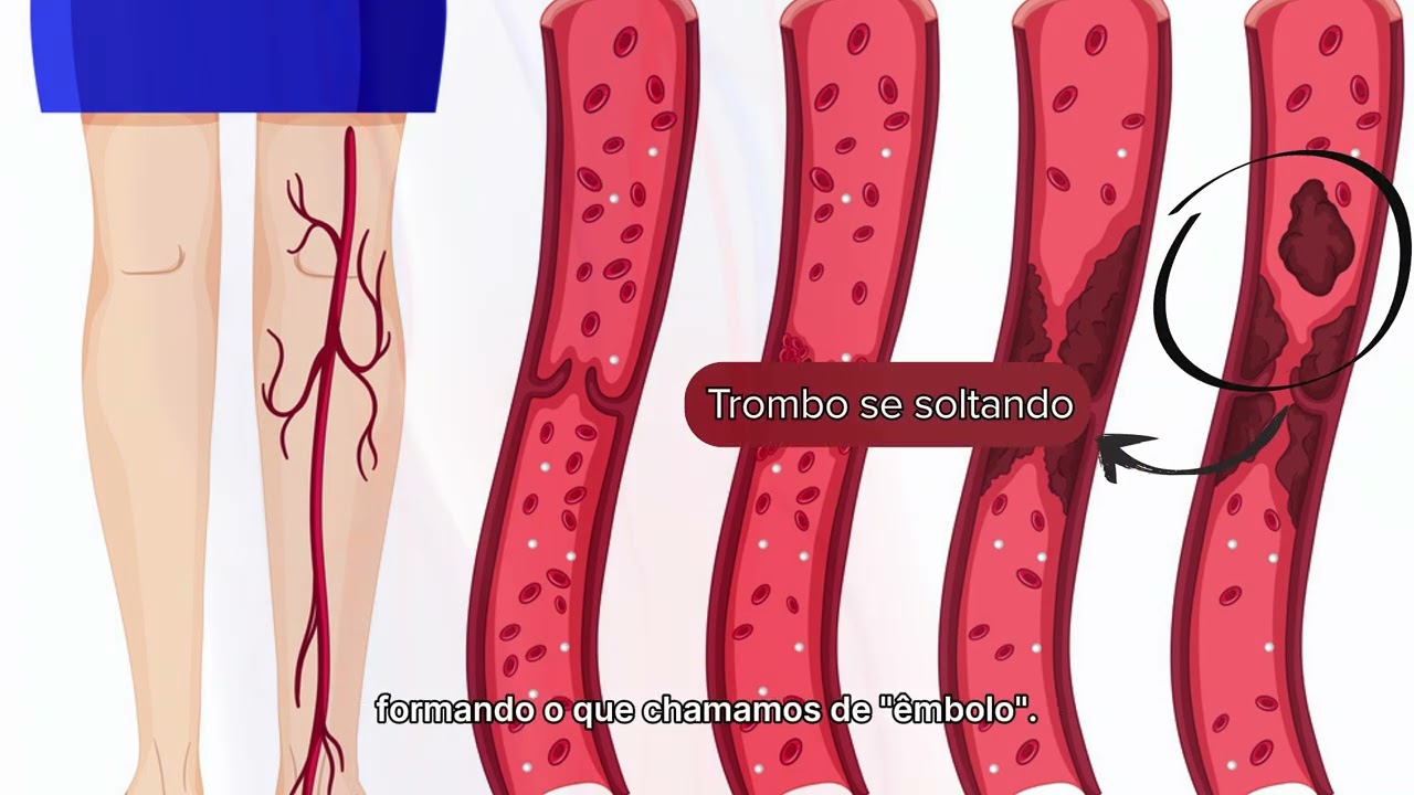 VÍDEO 1 - O que é trombose (tromboembolismo venoso)?