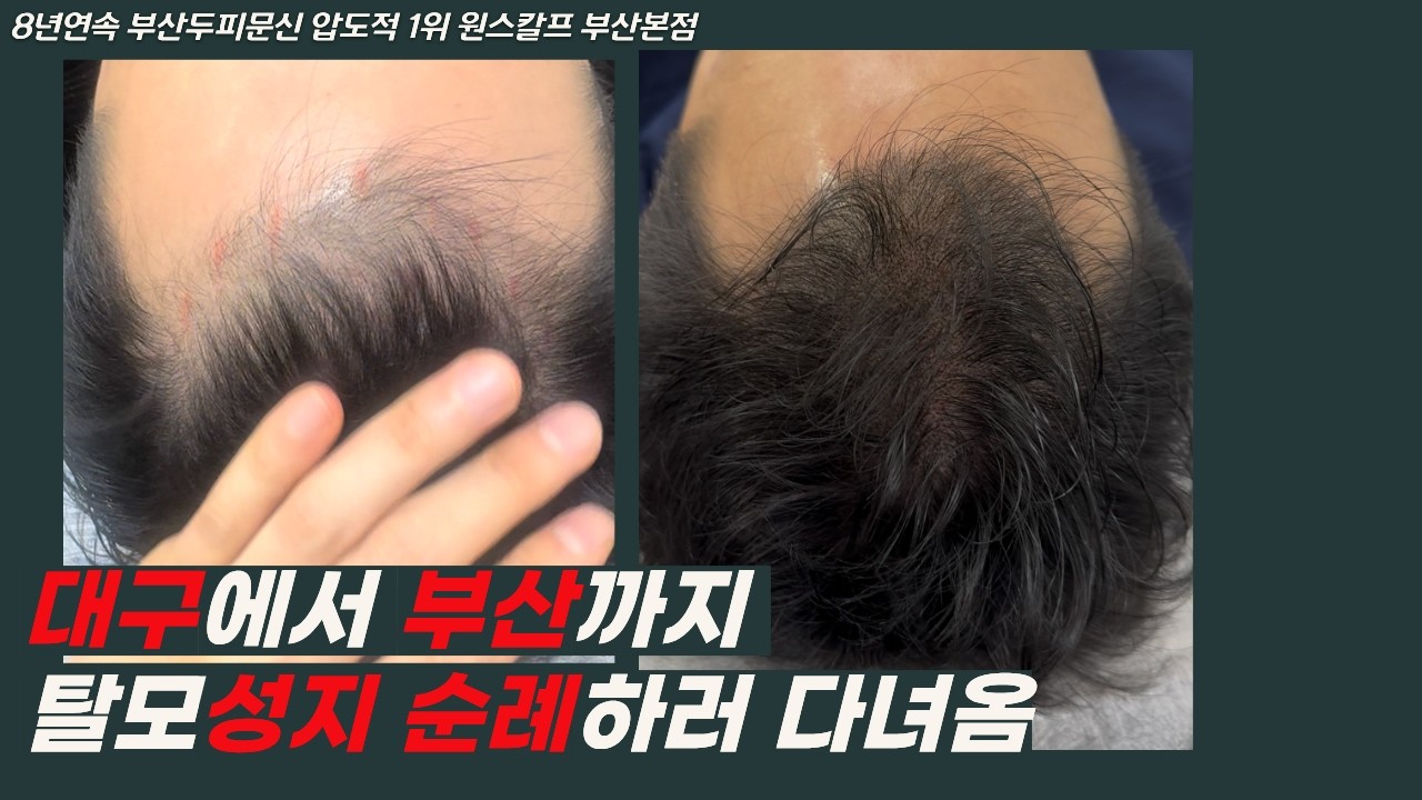 부산남자헤어라인두피문신 탈모성지 찾다 대구에서 방문한 이유