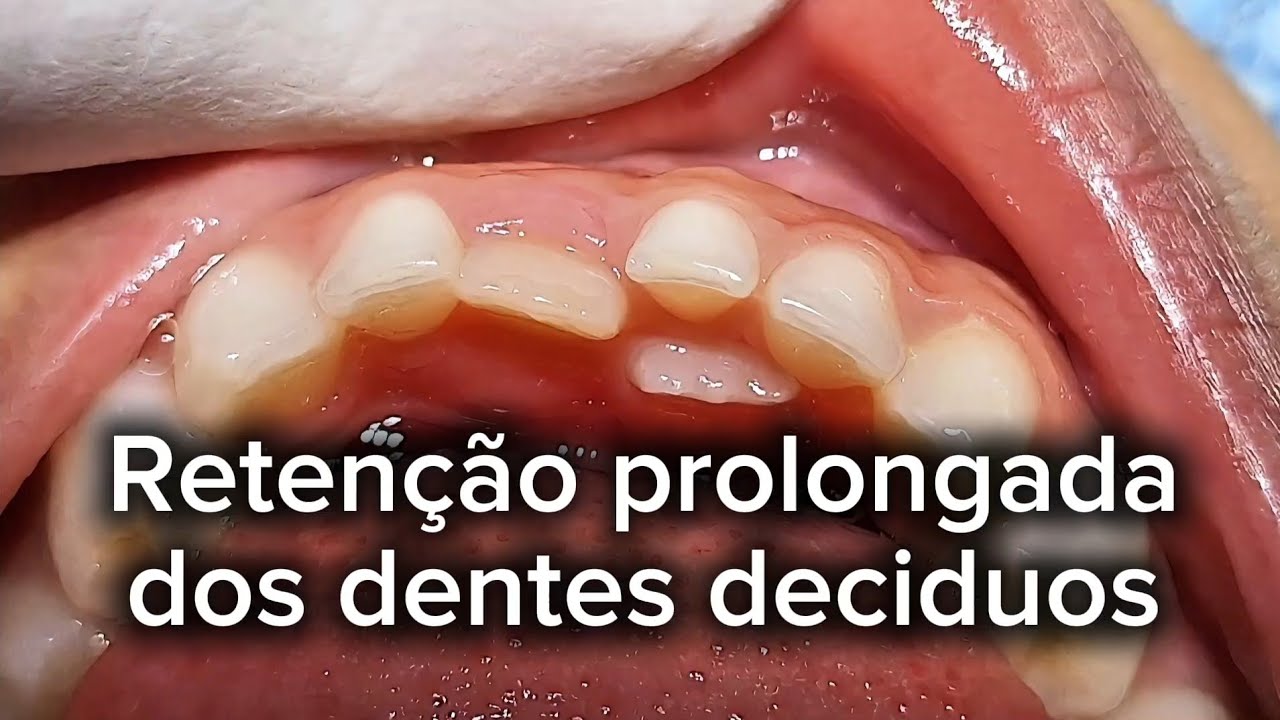 Dente nascendo montado?