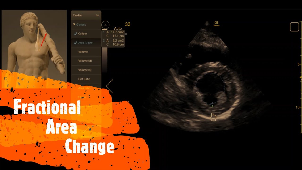 Fractional Area Change (FAC). Perioperative & Critical Care ECHO / POCUS