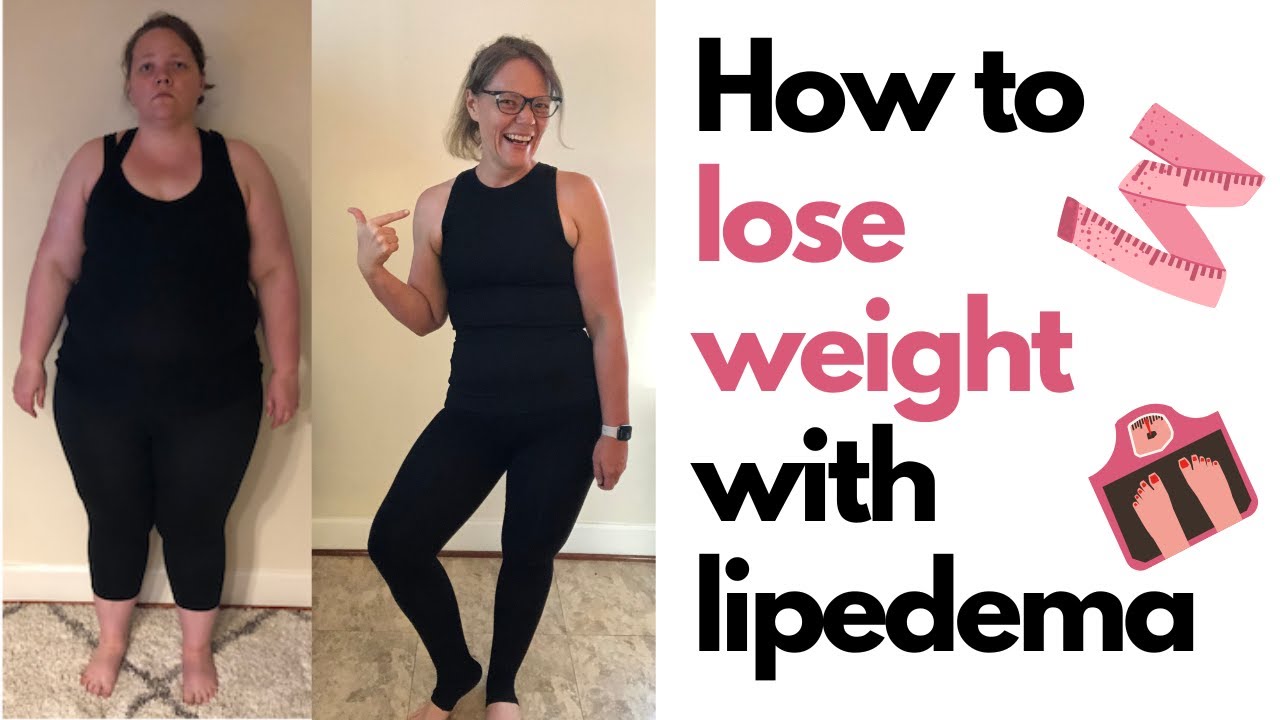 How to Lose Weight With Lipedema