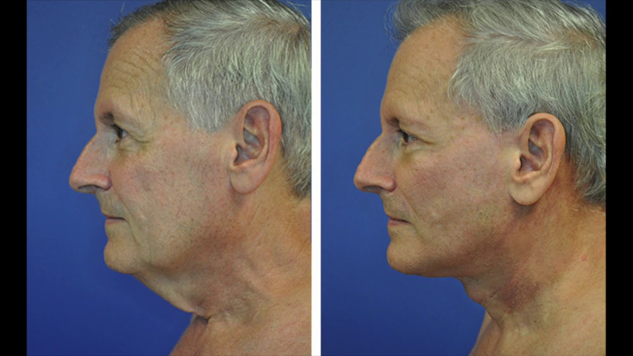 Mens Neck Lift | The Only HD Mens Neck Lift | HD Neck Lift by Dr. Andrew Ress