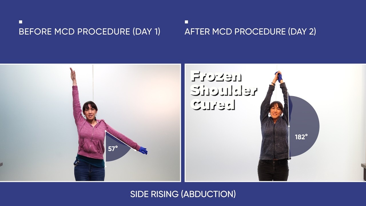 Months of Therapy Failed — Frozen Shoulder Improved in 2 Days
