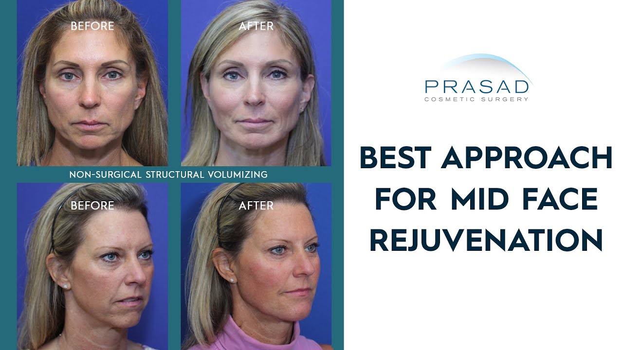 Why the Best Approach to Mid Face Rejuvenation May Not be a Mid Facelift
