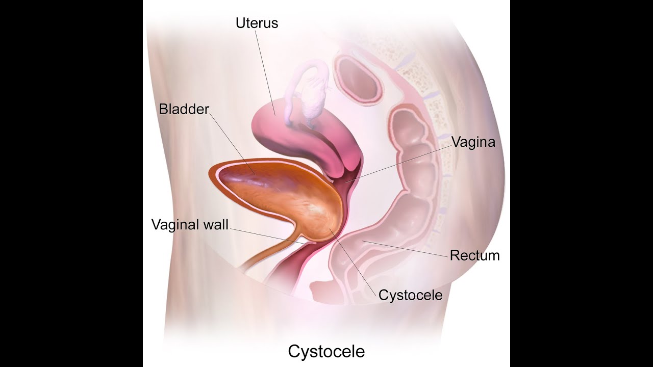 Anterior & Posterior Colporrhaphy | Cystocele | Rectocele | Mesh | Uterovaginal Prolapse - Dr Rams