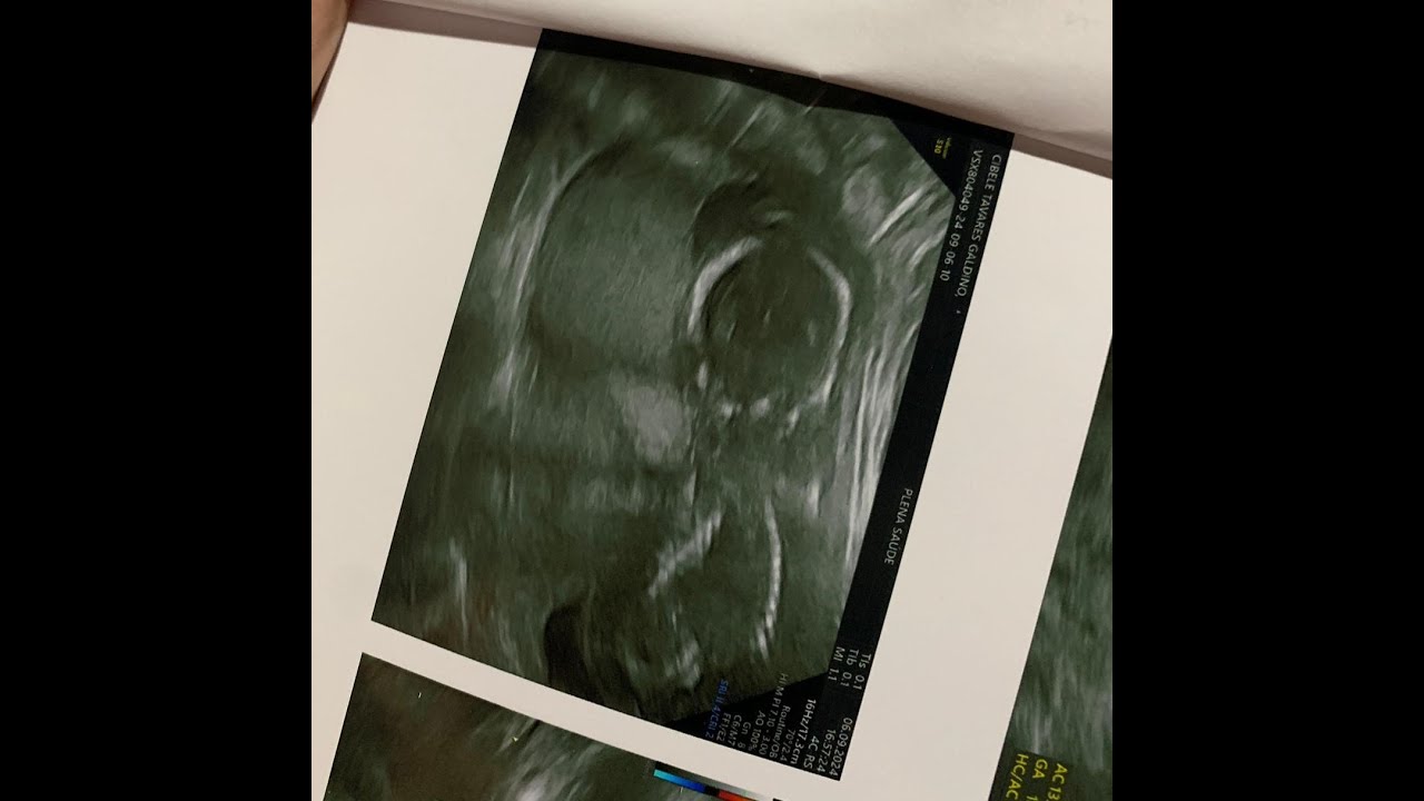 Síndrome de Turner, TN aumentada, Higroma Cístico, Derrame Pleural.  TESTEMUNHO MARIA CECÍLIA