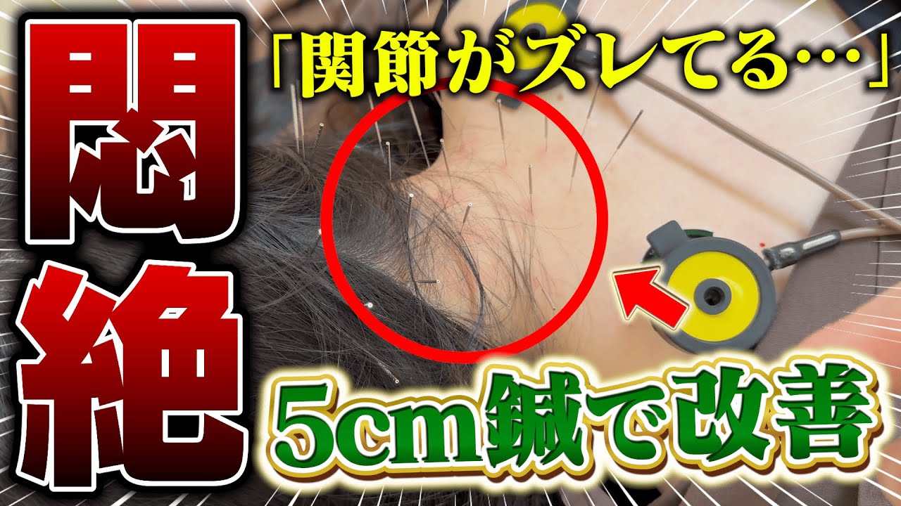 「関節の"構造"がズレてる…」ヘルニアと診断された患者様を鍼灸で救う！【20代女性】