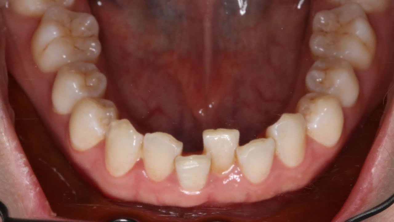 Why my after done with brace my case relapse ?/ብሬሥ ከተራችሁ በዃላ ችግሩ ተመልሷል?