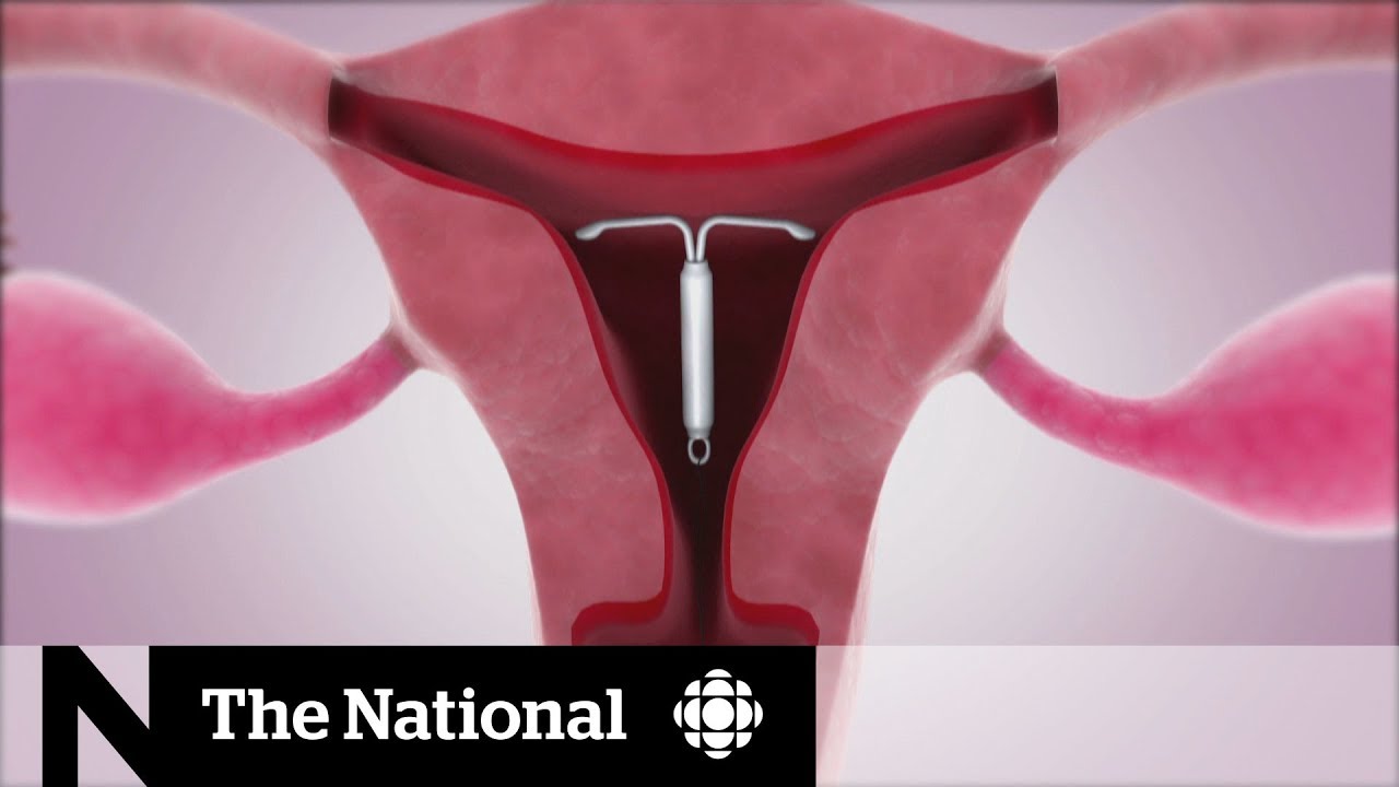 Prevent teen pregnancies &mdash;  IUDs recommended over pills