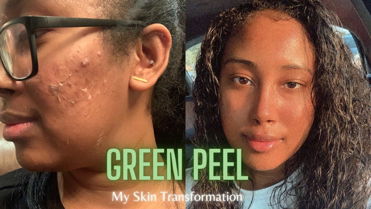 MY 6 MONTH SKIN TRANSFORMATION! | Dr. Schrammek Green Peel Changed My Skin