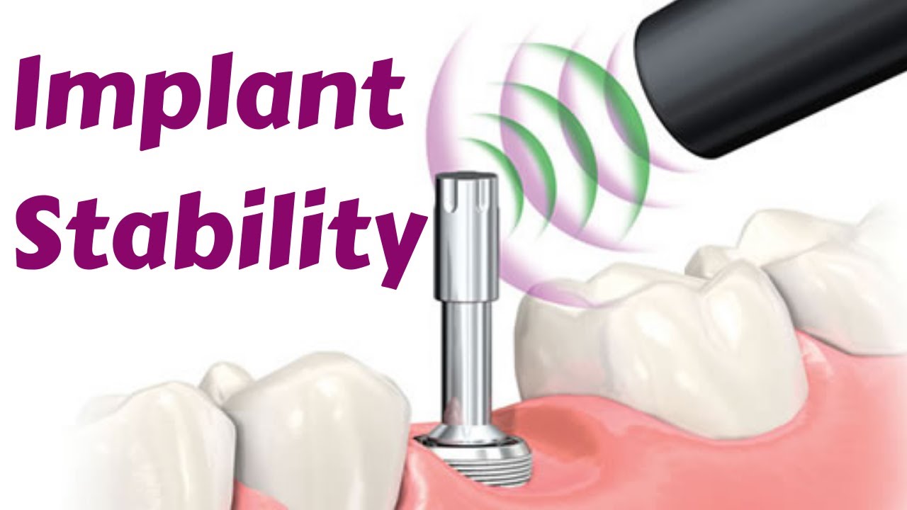 Implant Stability || primary vs Secondary Stability, Insertion Torque- Dental implant lecture/Course