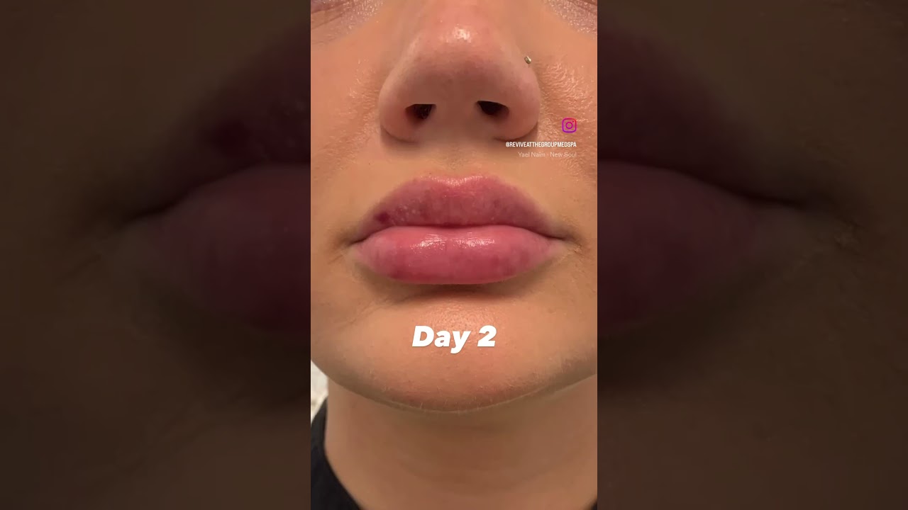 Lip Filler Progress Photos