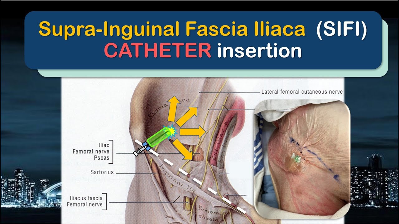 Supra-Inguinal Fascia Iliaca (SIFI) Catheter Insertion - the SUPRA-INGUINAL approach