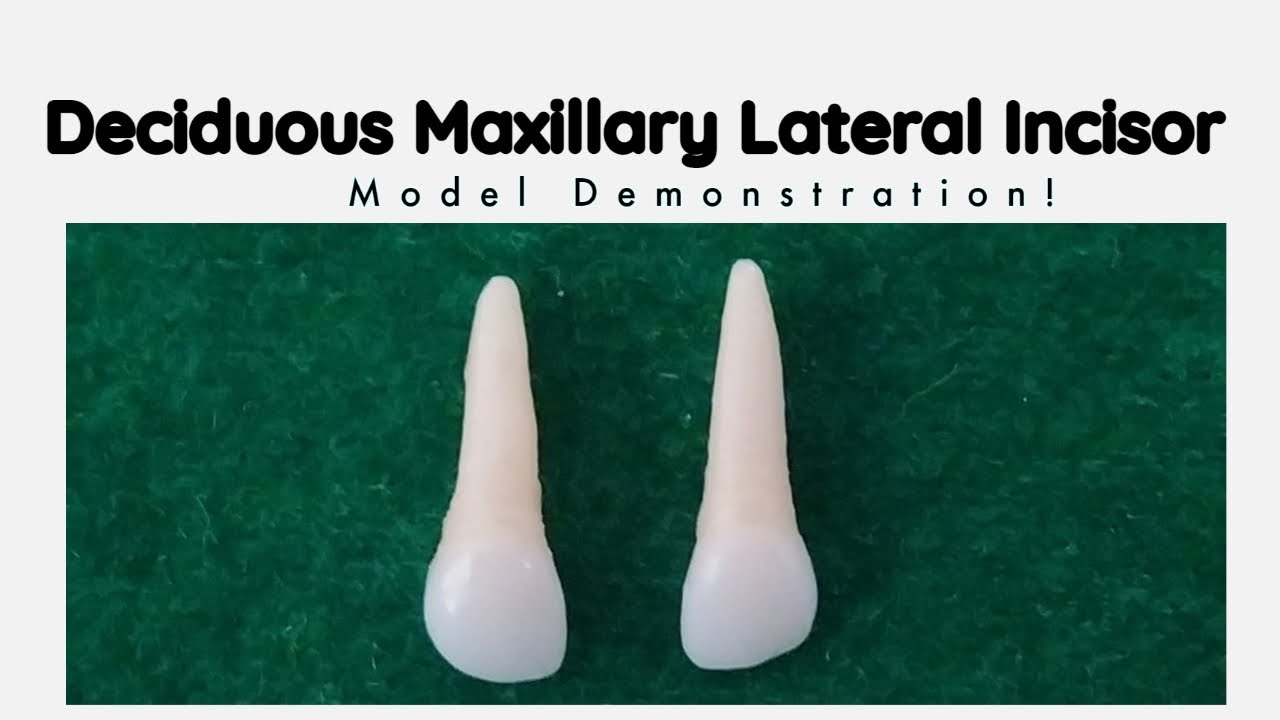 Deciduous Maxillary Lateral Incisor | Morphology of Primary Teeth