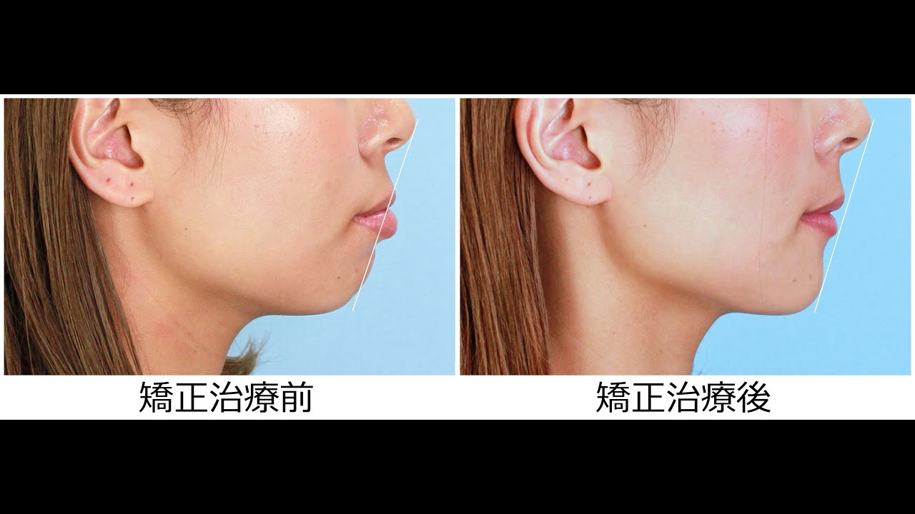 30歳 女性「口ゴボ を 治してほしい」 治療期間1年11か月　（上下顎前突症）