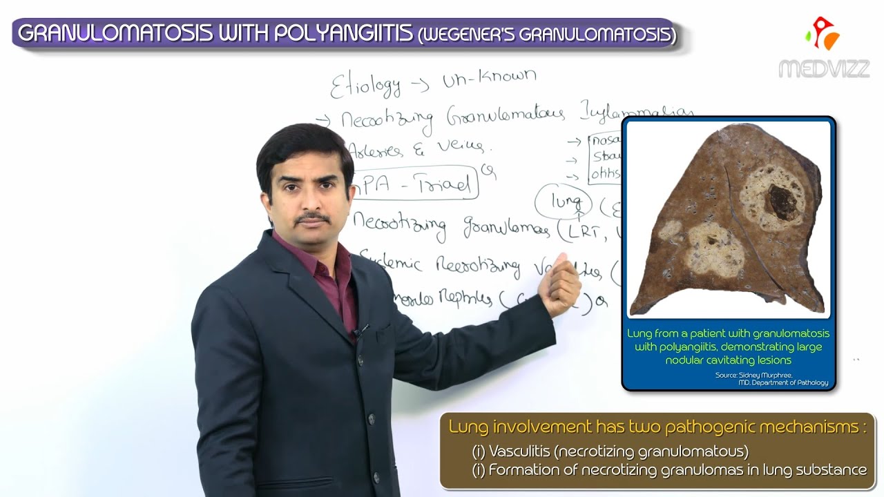 Granulomatosis with polyangiitis  / Wegener's granulomatosis - Usmle step 1 : Dr G Bhanu Prakash