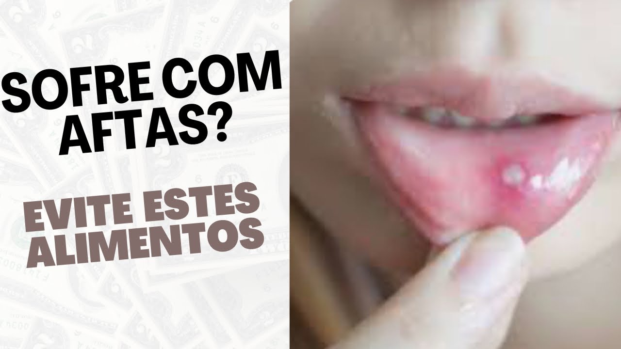 Tenho afta com frequência - O que fazer? Quais alimentos e bebidas precisam ser evitadas?