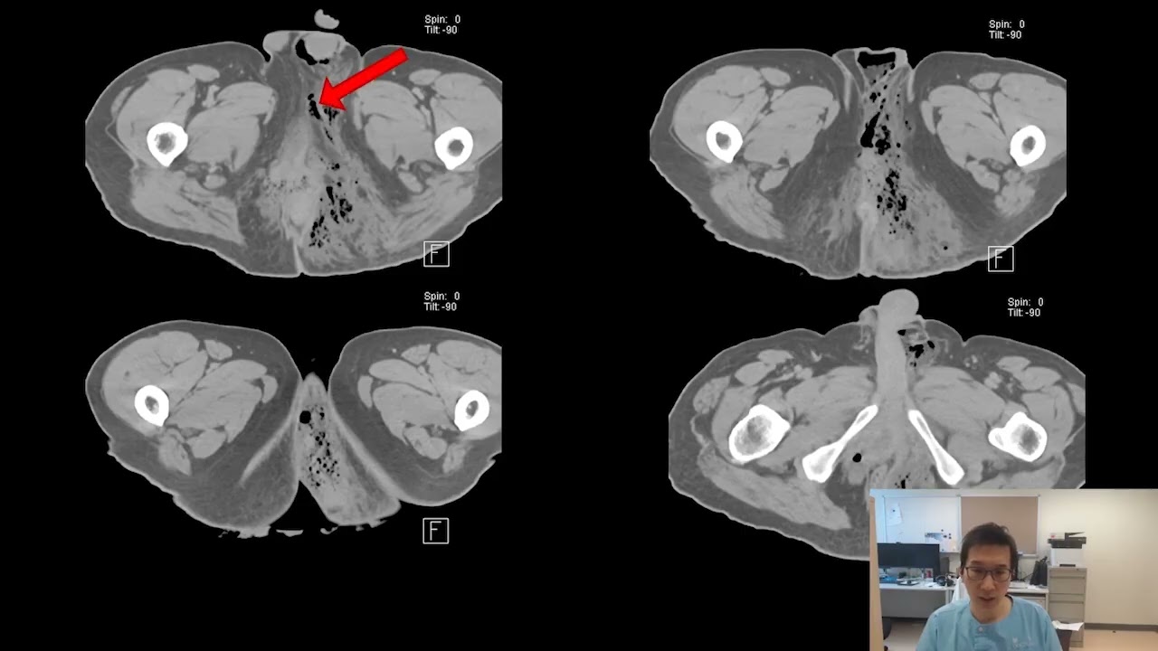 Role of Radiology in Sepsis