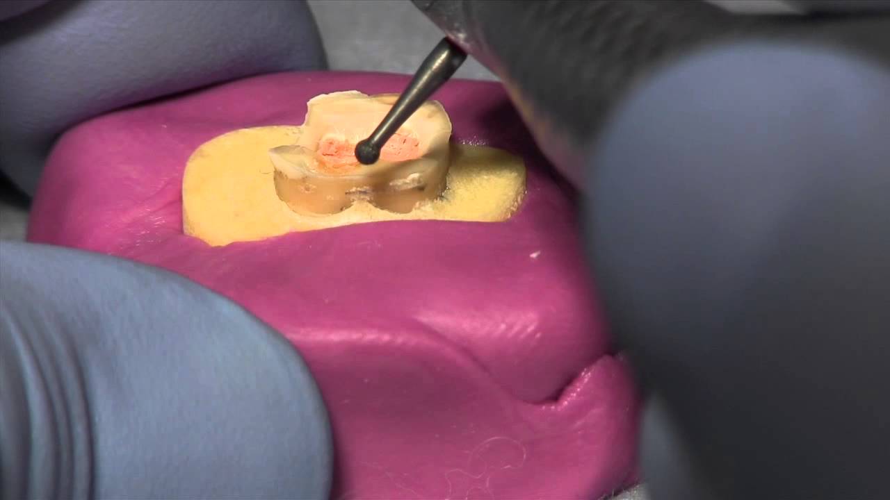 Removing  Gutta Percha for a Post and Core