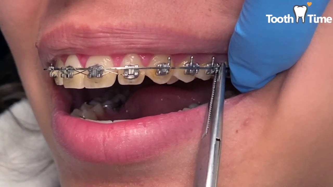 Lace ties and Power chains - Braces Tooth Time Family Dentistry New Braunfels