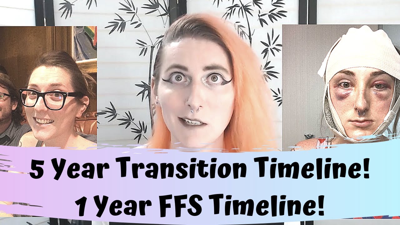 Facial Feminization Surgery (FFS) & Transition Timeline | 1 Year Later | MTF Transgender