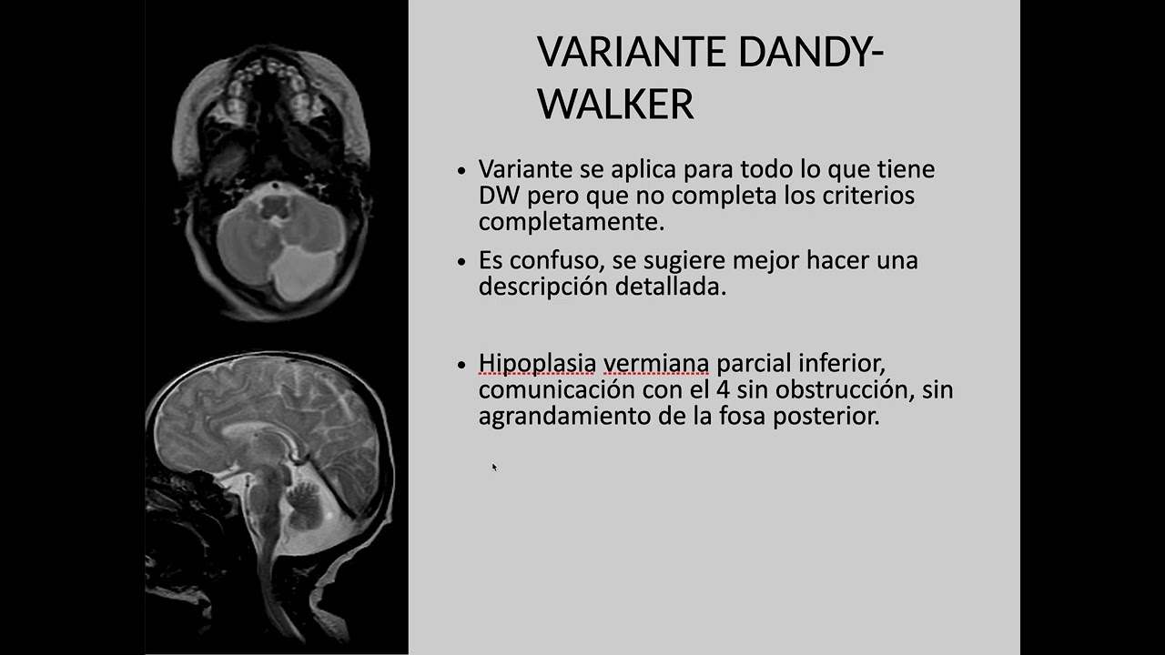 MALFORMACIONES CONGENITAS DEL SNC 6 DR  PARRA