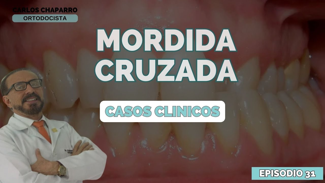 Resolución caso clínico - MORDIDA CRUZADA - Episodio 31
