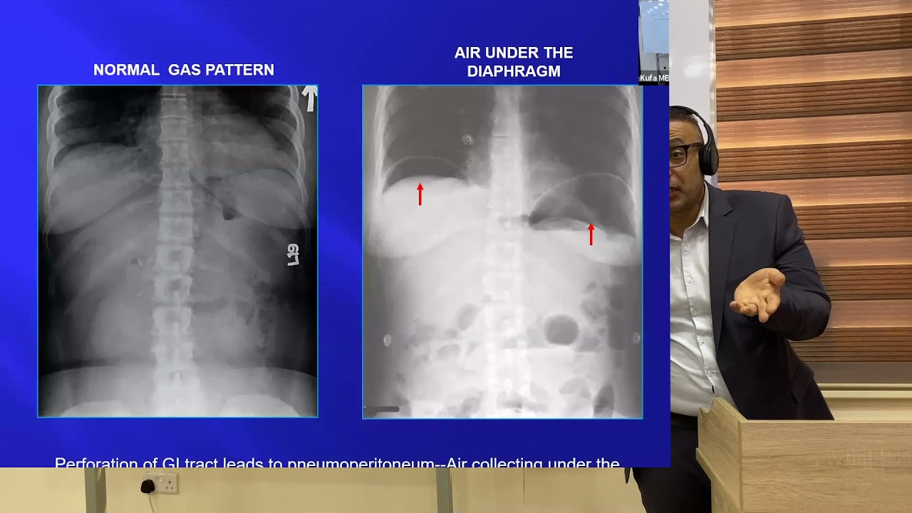 plain abdomen 1