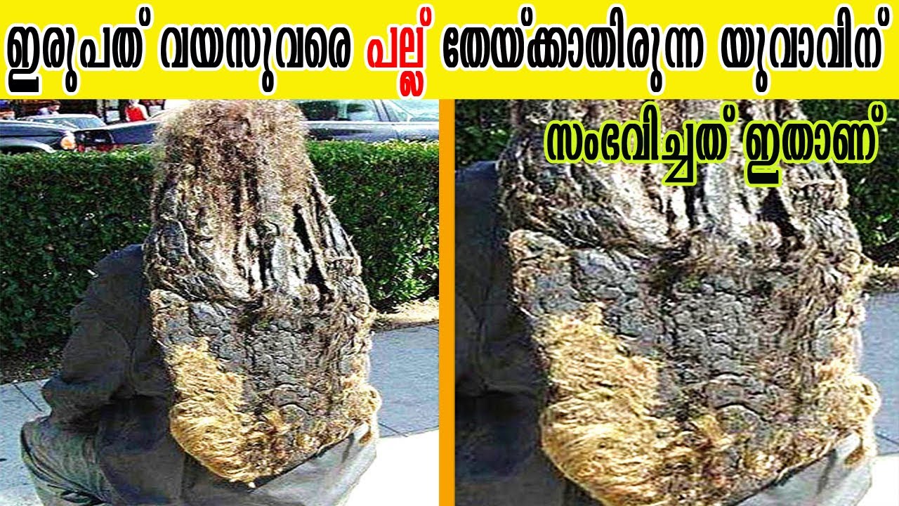 ഇരുപത് വയസുവരെ പല്ല് തേയ്ക്കാതിരുന്ന യുവാവിന് സംഭവിച്ചത്| ഇങ്ങനേയും മനുഷ്യരുണ്ടെന്ന് വിശ്വസിക്കില്ല!
