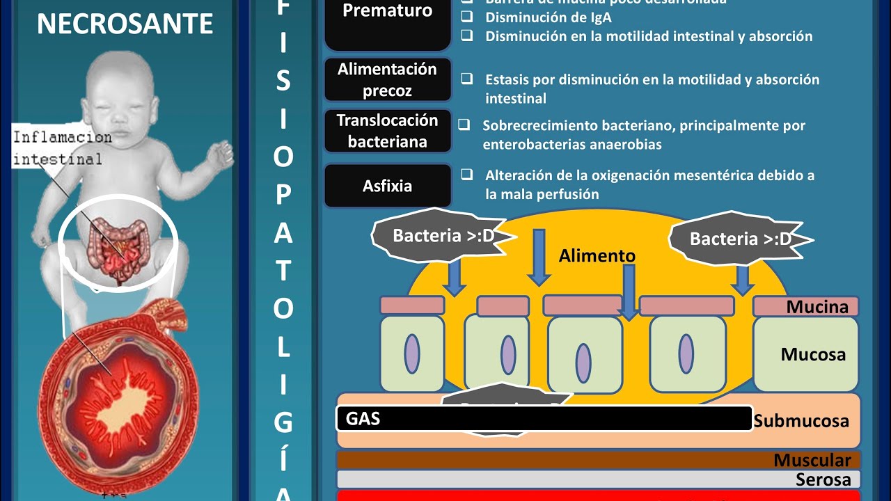 Enterocolitis necrosante neonatal: fisiopatología, criterios de Bell, tratamiento #enarm