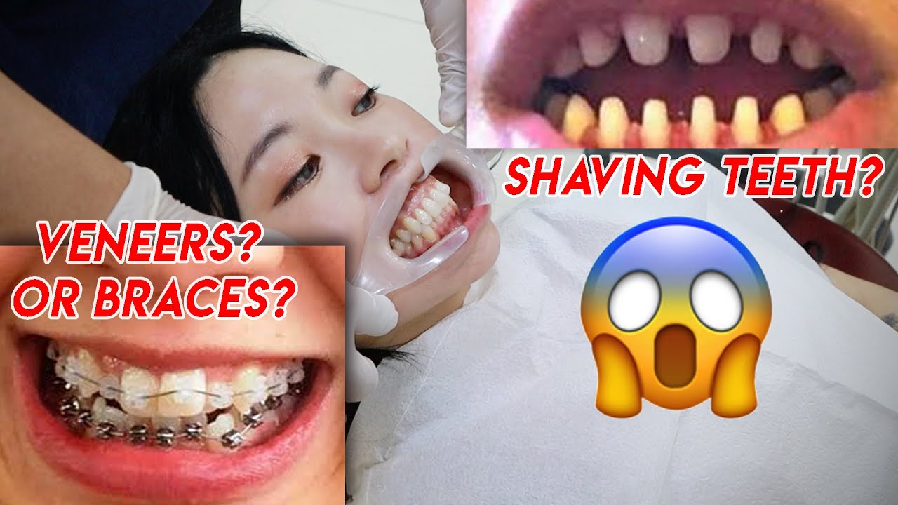 I'm finally straightening my teeth in Korea! Invisalign vs Braces vs Veneers?!