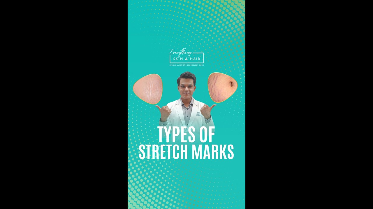 Types of Stretch Marks