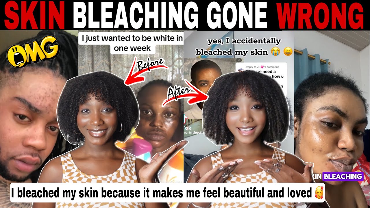 MERCY!😱 SKIN BLEACHING GONE WRONG! THE RISK BEHIND THE SKIN LIGHTENING CRAZE + COLORISM | TIKTOK