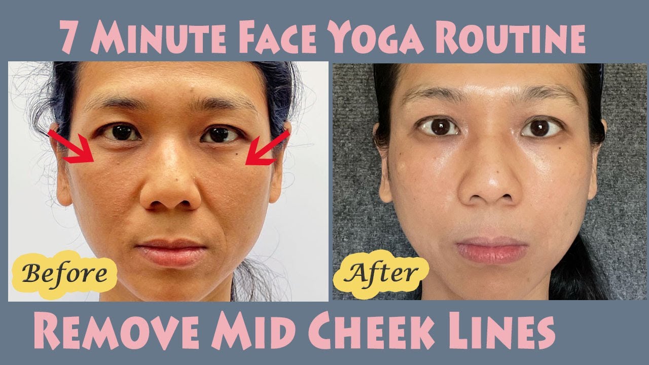 Face Yoga Routine to Remove Mid Cheek Lines. 7 Minute Follow Along Routine for Tear Through Lines