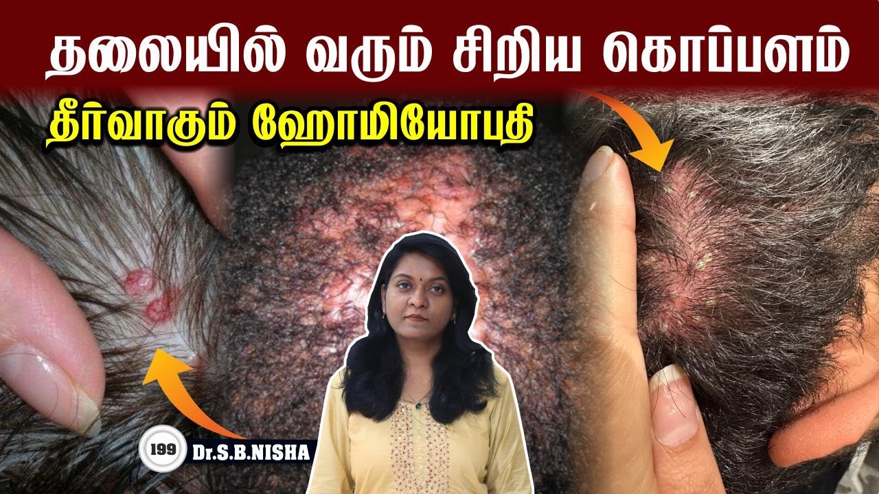 தலையில்  சிறிய கொப்பளம் வருகிறதா ? தீர்வு தரும் ஹோமியோபதி | Hair Folliculitis | Homeopathy| Dr.Nisha