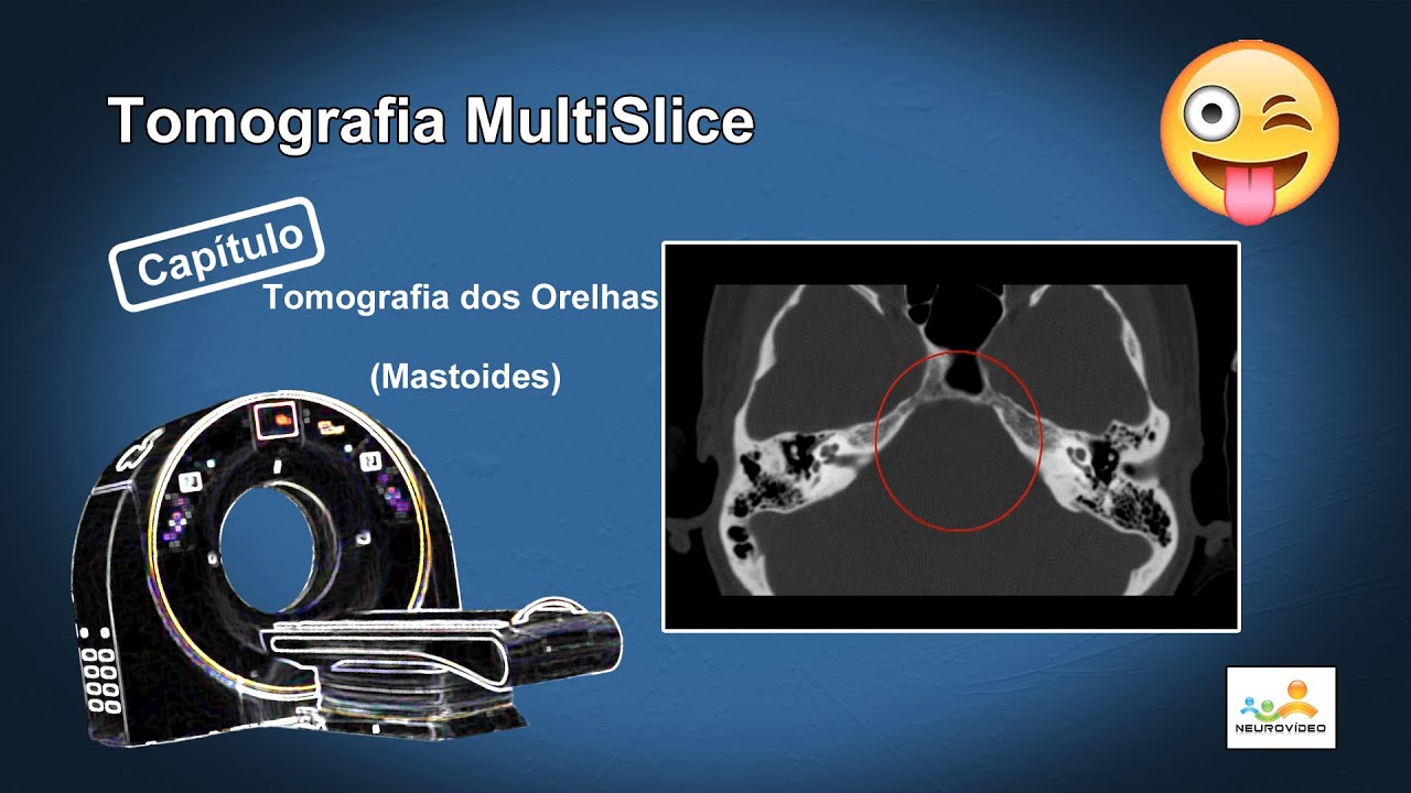 Tomografia dos Orelhas (Mastoides) (Dicas e Truques)