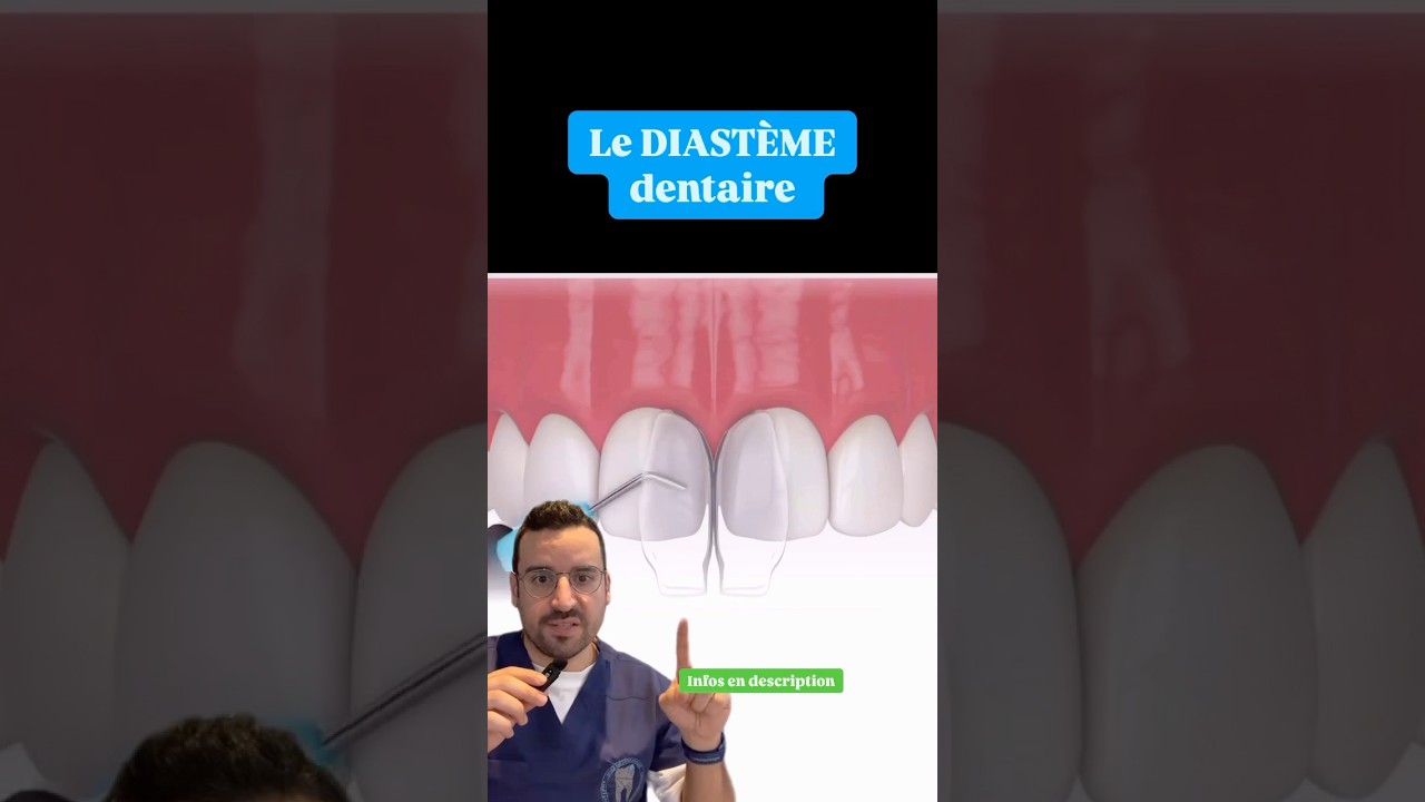 DIAST&Egrave;ME : la SOLUTION au COMPOSITE dentaire