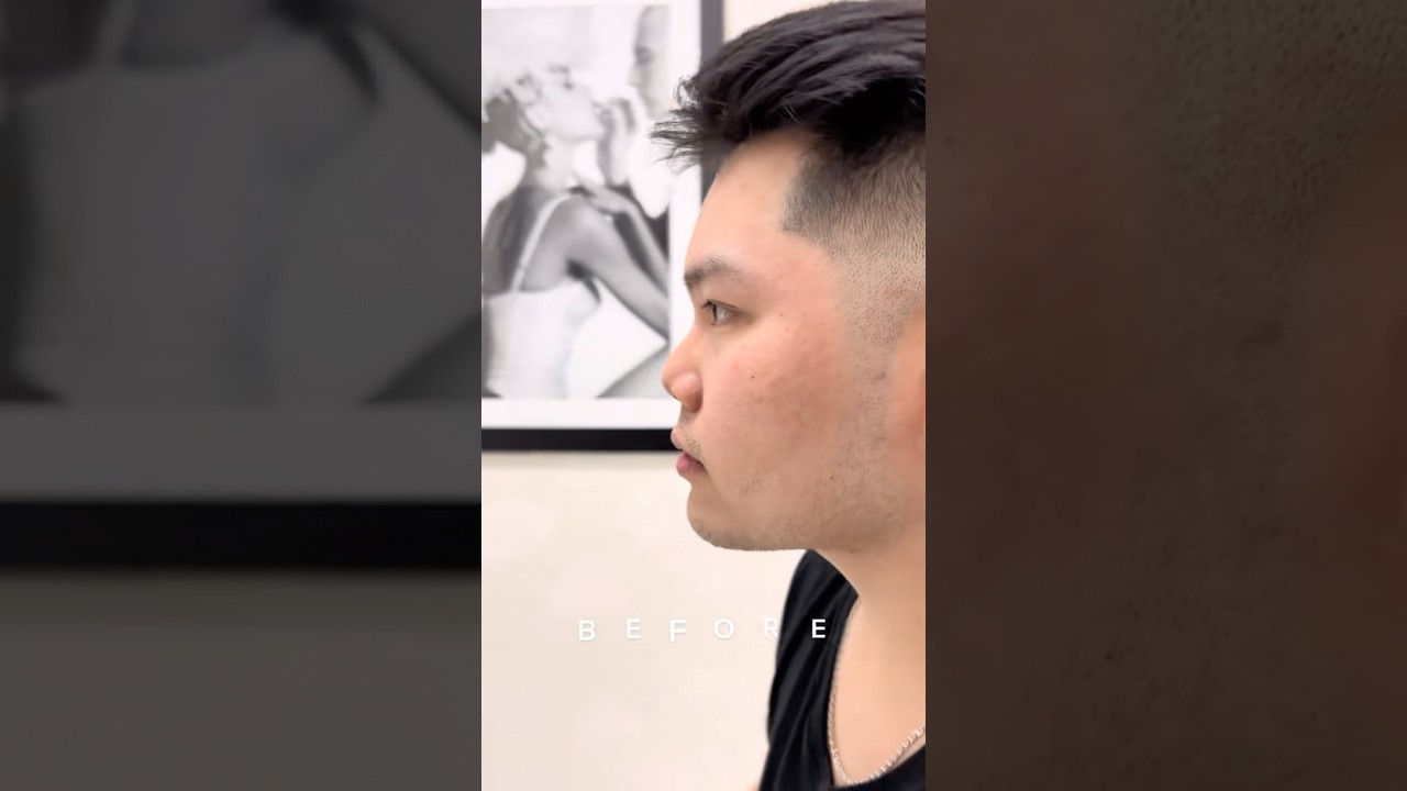 Male Asian Rhinoplasty Before and After #nosejob #rhinoplasty