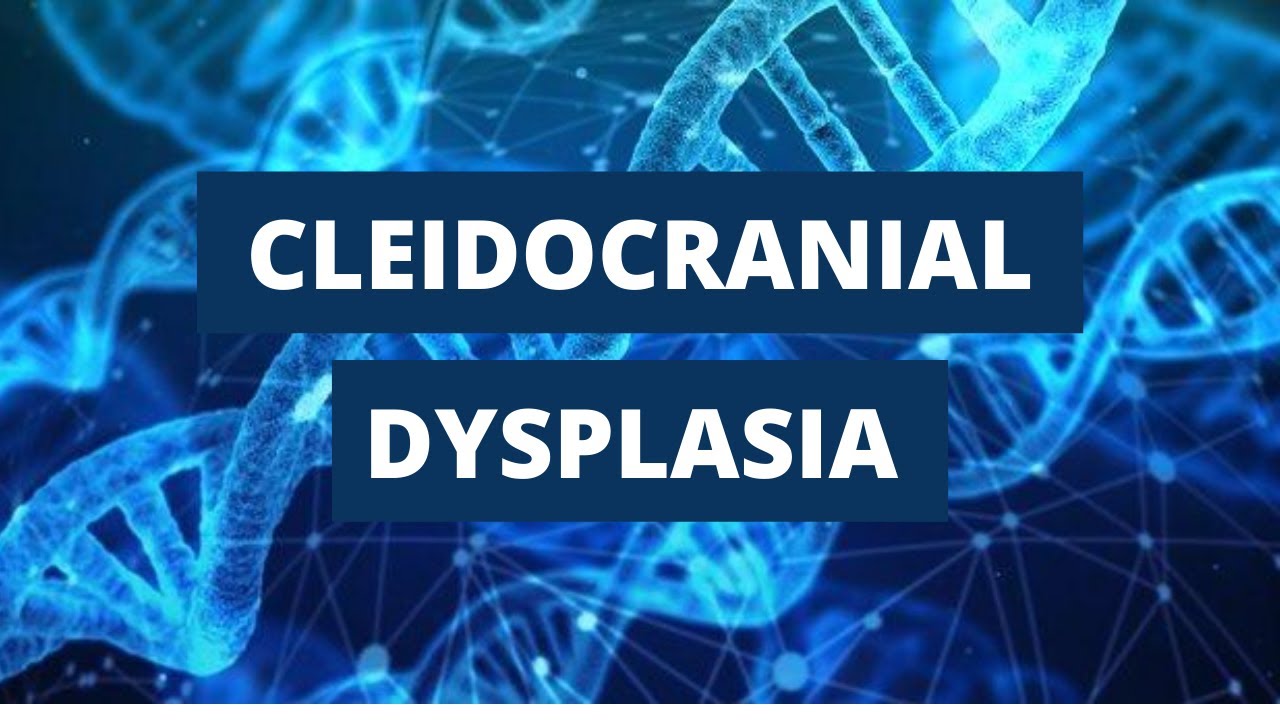 Cleidocranial Dysplasia -Introduction, Etiology, Clinical Features, and Treatment.