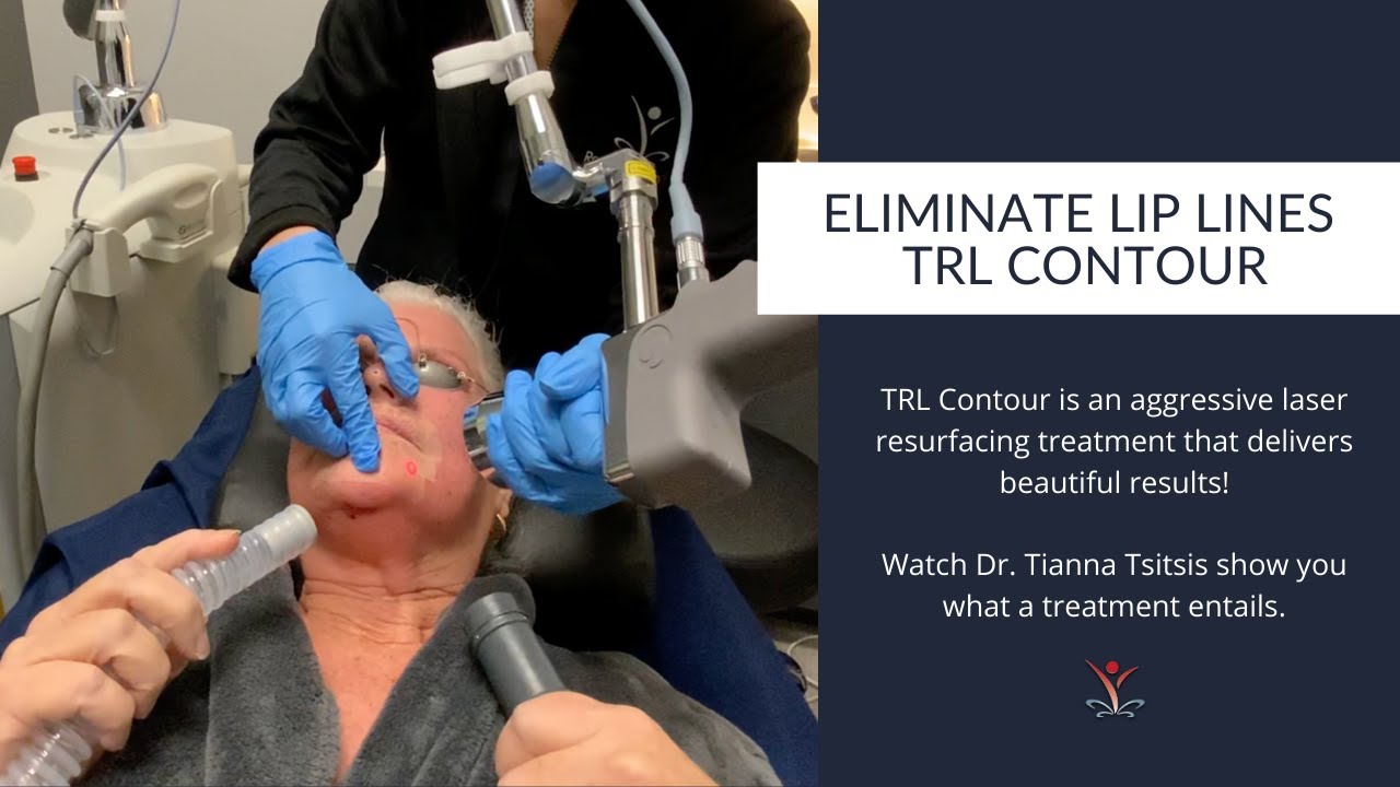 Eliminate Lip Lines with Sciton's TRL Contour Laser