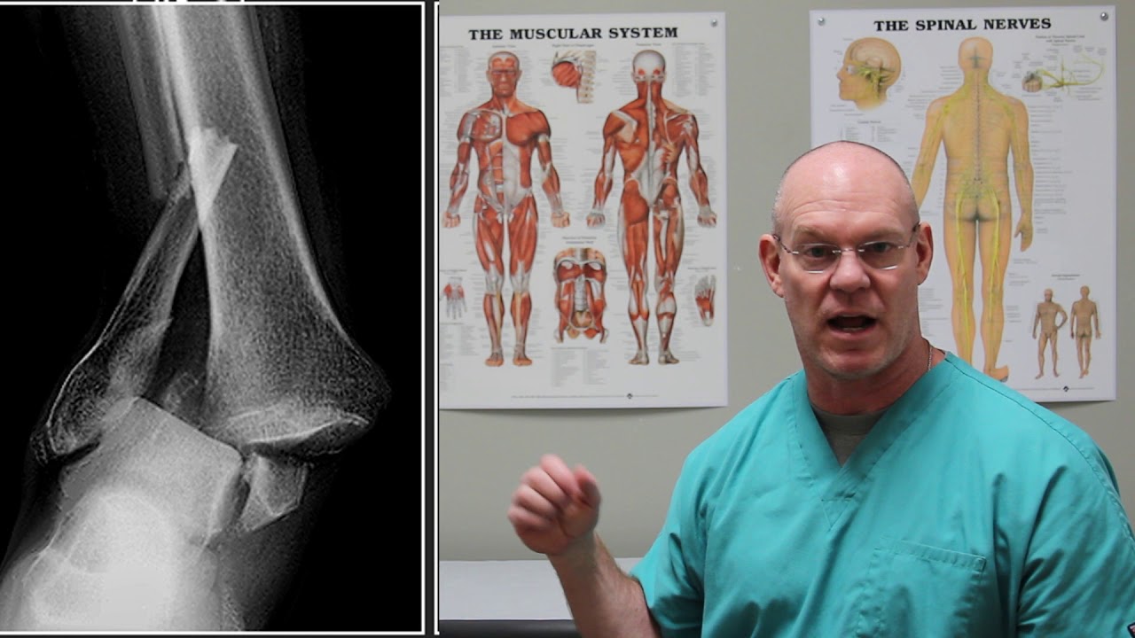 Complex Ankle Fracture | Fracture Friday Episode 37