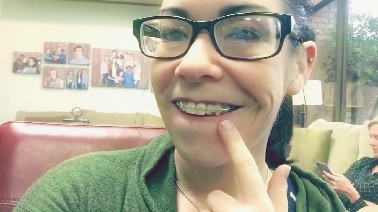 Adult Braces - Wire Change & Broken Bracket