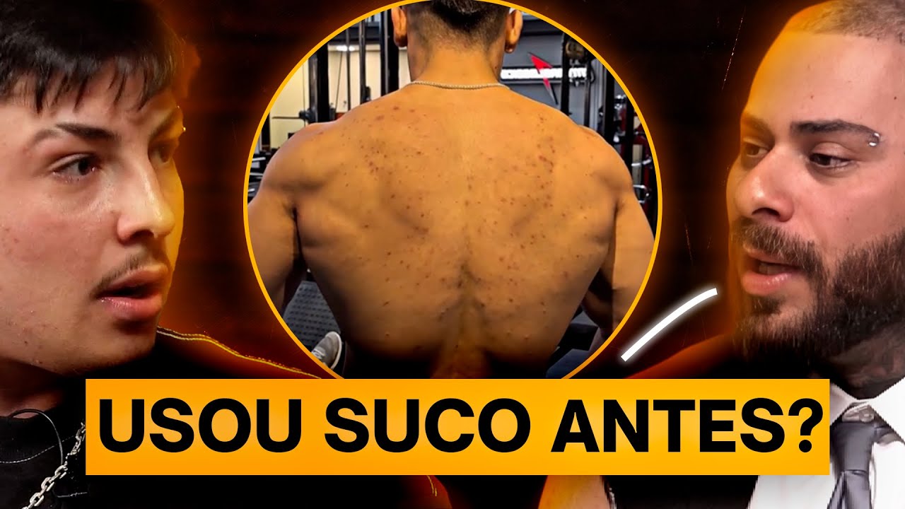Ganley MENTIU SOBRE SER NATURAL? L&eacute;o Stronda questiona sobre espinhas