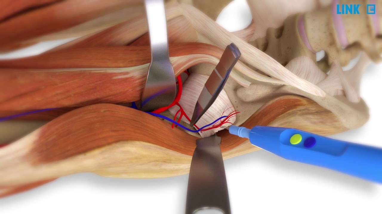 LINK Direct Anterior Approach