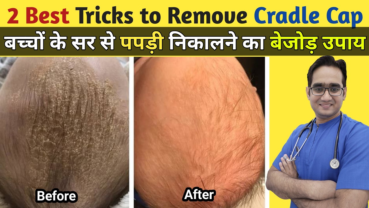 Step-by-Step Process to Clean Cradle Cap From Your Baby’s Head | Dr Md Noor Alam