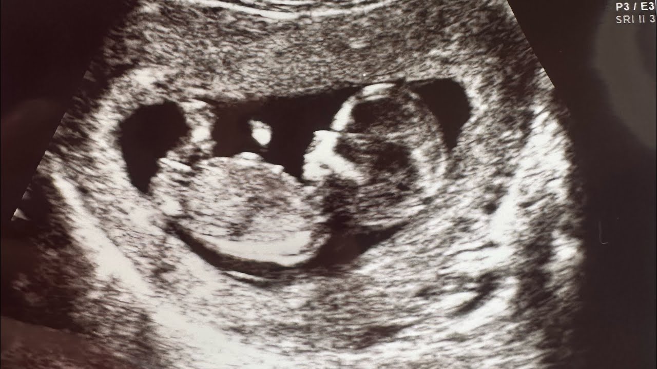 🤰Ժամանակն է կիսվել Ձեզ հետ այս ՆՈՐՈՒԹՅԱՄԲ💙🩷\Զրուցենք😊
