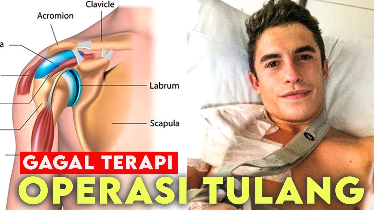 CEDERA TULANG MARC PARAH ⁉️😱 TERAPI GAGAL….BEDAH DILAKUKAN ‼️ BEZZECCHI BIKIN AMSYONG 😰