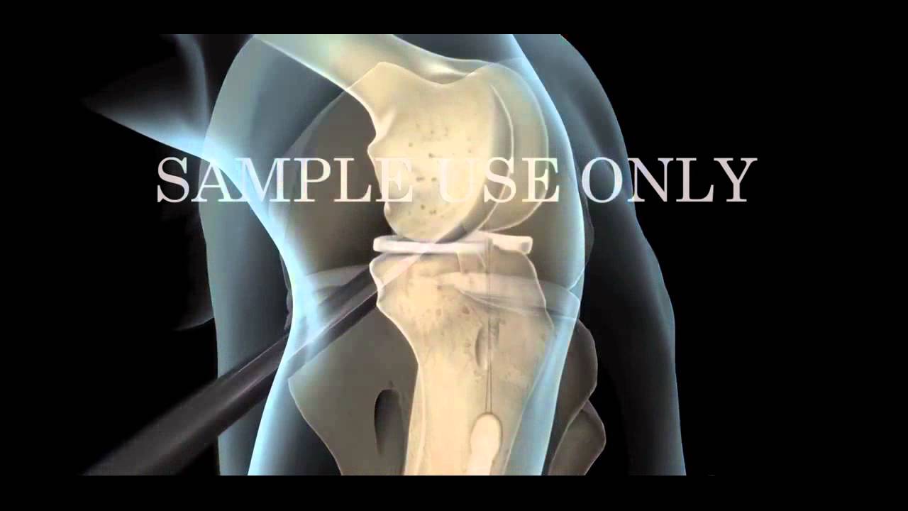 Joint Replacement Surgery in Bangalore | ACL Reconstruction Surgery Animation | Knee Surgery India